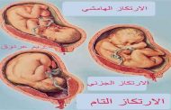 هكذا يُمكن أن تتأثّر المشيمة بالولادة القيصريّة...!