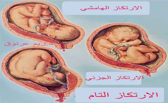 هكذا يُمكن أن تتأثّر المشيمة بالولادة القيصريّة...!