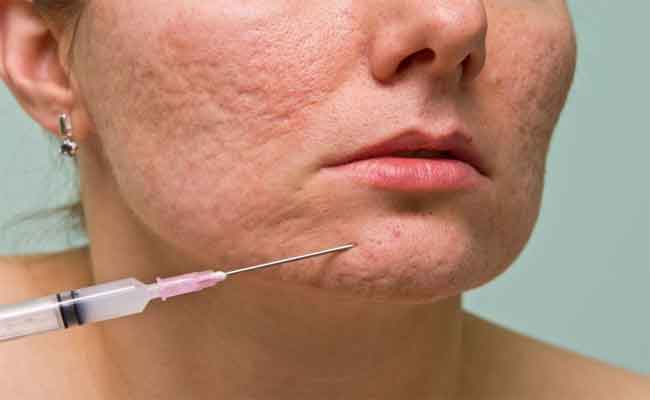 ما هي خطوات جراحة تجميل ندبات الوجه...؟