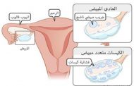 هل من الممكن أن يسبب المبيض متعدد الكيسات العقم...؟