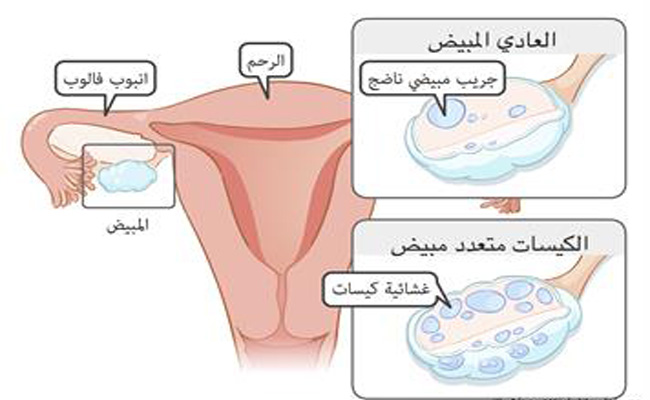 هل من الممكن أن يسبب المبيض متعدد الكيسات العقم...؟
