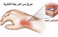 علاجات بسيطة للحروق الناتجة عن المشروبات الساخنة...