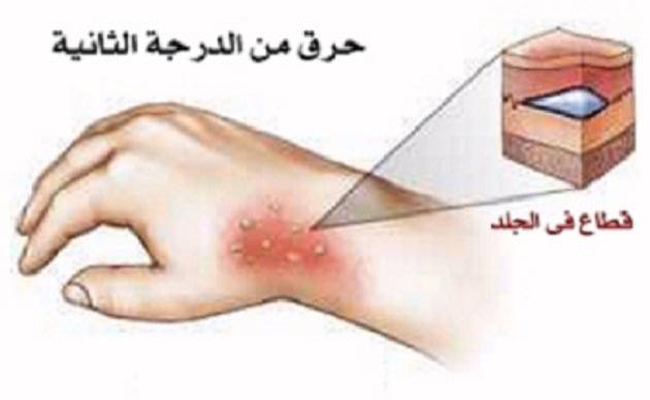 علاجات بسيطة للحروق الناتجة عن المشروبات الساخنة...