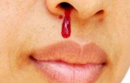 كيف تتصرفون عندما تعانون من نزيفٍ في الأنف...؟