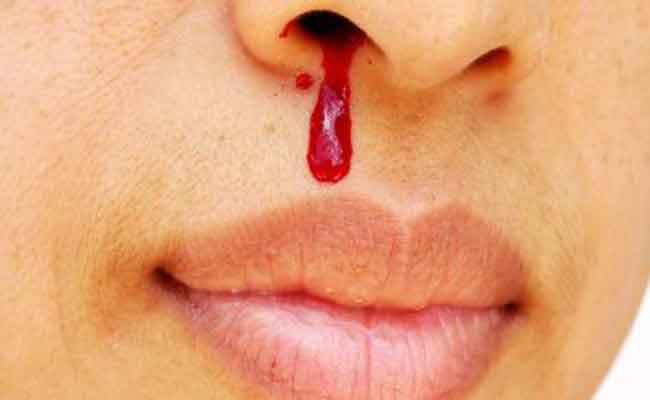 كيف تتصرفون عندما تعانون من نزيفٍ في الأنف...؟