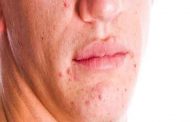 كيف يمكنك علاج حب الشباب عند التخطيط للحمل...؟