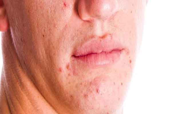 كيف يمكنك علاج حب الشباب عند التخطيط للحمل...؟