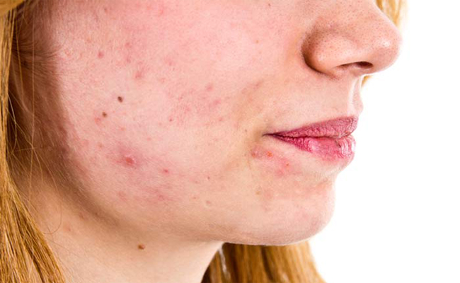 طرق ستساعدك للتخلص من البقع البنية في الوجه...!