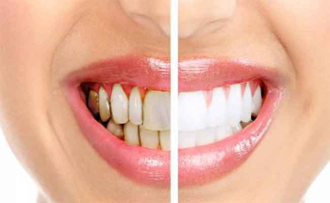 كيف تتعاملين مع التهاب اللثة خلال الحمل...؟
