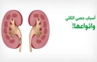 ما الذي يسبّب حصوة الحالب...؟