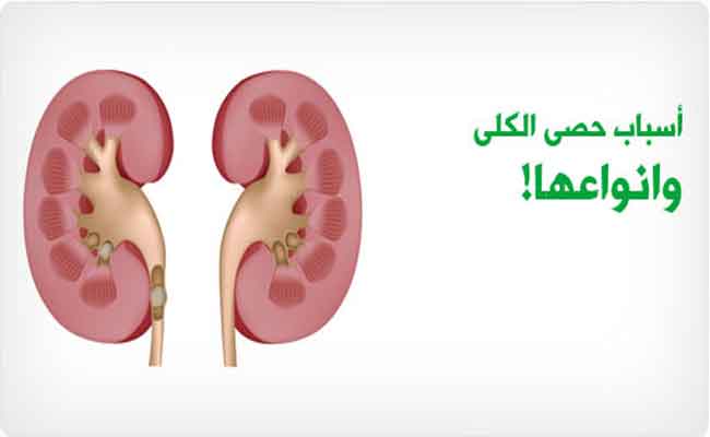 ما الذي يسبّب حصوة الحالب...؟