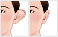 ما هي تقنيات تجميل الأذنين من دون جراحة...؟