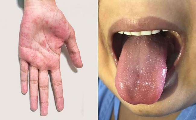 مرض الكاواساكي يظهر من جديد في سطيف