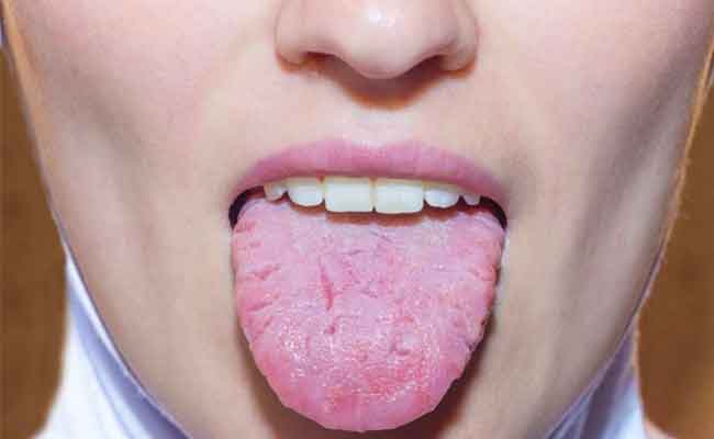 هل التهاب اللسان يشير الى انّكم مصابين بفيروس كورونا؟...