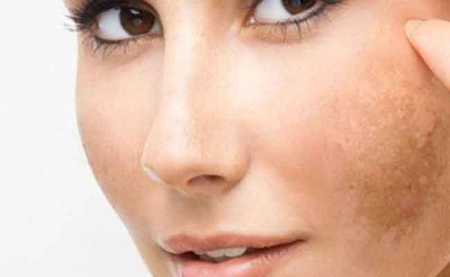 هل هناك علاجات فعّالة لكلف الحمل؟...
