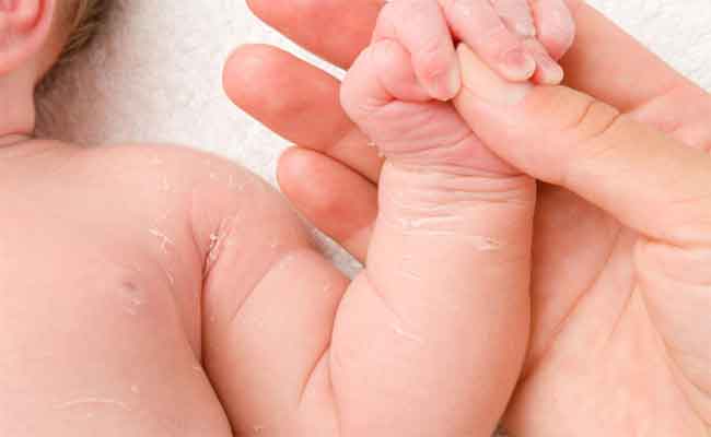 هل تقشّر جلد طفلكِ الرضيع طبيعي؟...