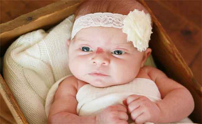 ما هي الوحمة عند الرضيع؟ ومتى تتطلّب علاجاً طبياً؟...