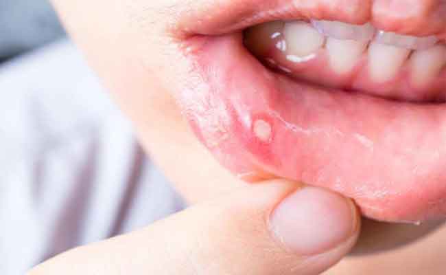 كلّ ما يجب أن تعرفيه حول تقرّحات الفم خلال الحمل وطرق علاجها!...