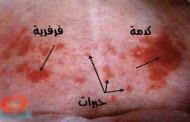 تأثيرات لافتة يجب أن تعرفوها للصدفية على حياتكم الجنسية!