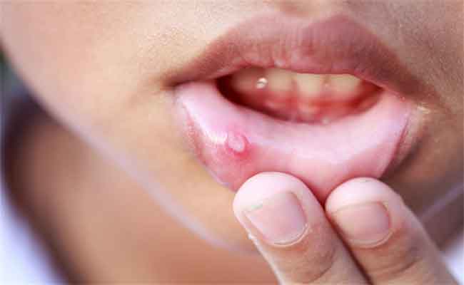 أي علامات تشير الى اصابتكم بعدوى الخميرة في الفم؟