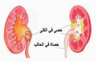 هل من مضاعفات صحيّة لعمليّة ازالة حصى الكلى؟