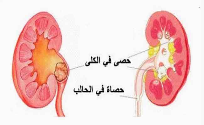 هل من مضاعفات صحيّة لعمليّة ازالة حصى الكلى؟