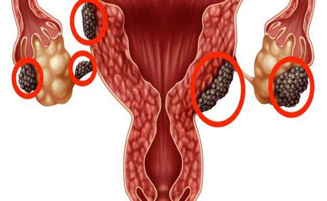 علامات شائعة تدلّ على الإصابة بالانتباذ البطاني الرحمي...