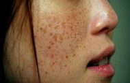 النمش...ما هي الأسباب؟ وأحدث العلاجات؟