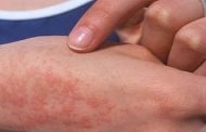 تسجيل إصابة 31 شخصا بالحمى المالطية بباتنة