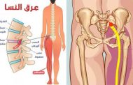 ما هو عرق النسا؟ وكيف يمكن علاجه؟