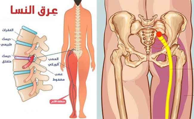 ما هو عرق النسا؟ وكيف يمكن علاجه؟