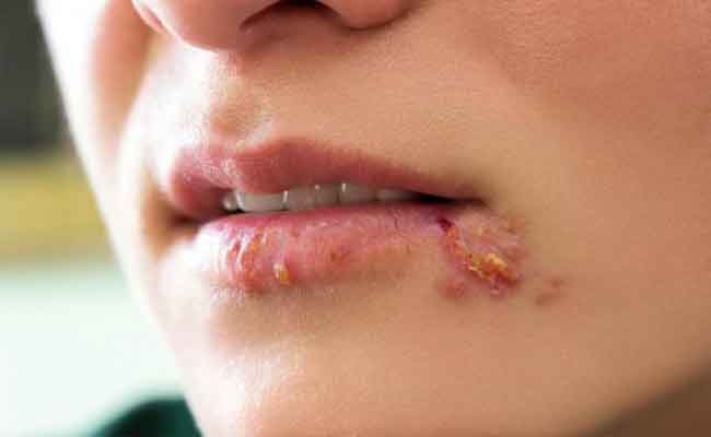 هل يمكن علاج فيروس الهربس والتخلّص منه نهائياً؟