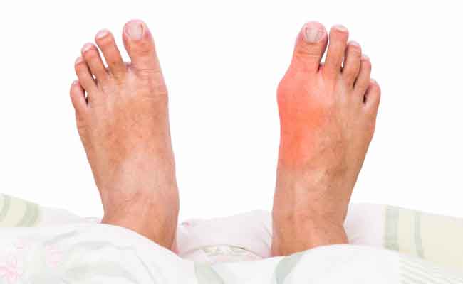 4 خطوات مهمّة للسيطرة على اعراض مرض النقرس