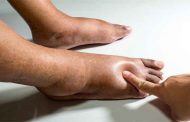 كيف تتعرفون على أعراض احتباس الماء تحت الجلد؟ وما هي طرق علاجه؟