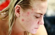 حب الشباب يؤثر سلباً على نفسية المراهق...7 مخاطر محتملة