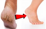 كيف يمكن التخلص من تشققات القدمين منزلياً؟