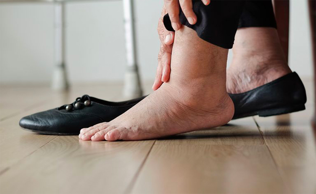 كيف تتعرفون على أعراض احتباس الماء تحت الجلد؟ وما هي طرق علاجه؟