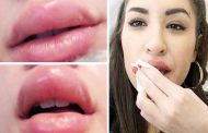 مخاطر محتملة لتكبير الشفاه يجب الاطّلاع عليها قبل العملية