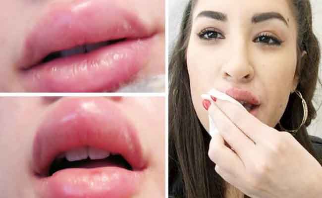 مخاطر محتملة لتكبير الشفاه يجب الاطّلاع عليها قبل العملية