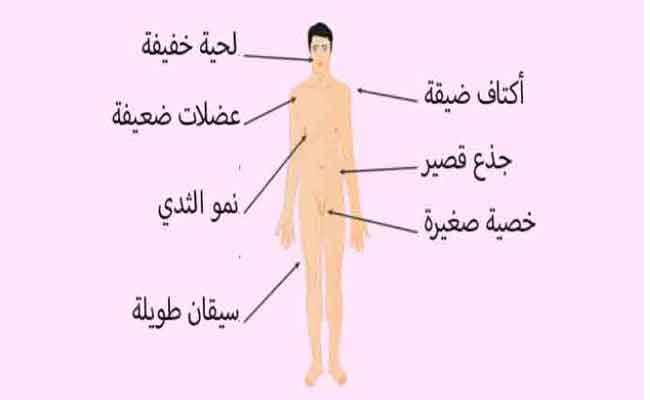 ماذا تعرفون عن متلازمة كلاينفلتر؟