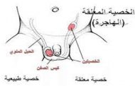 ما هي المضاعفات الصحية لوجود الخصية خارج كيس الصفن؟