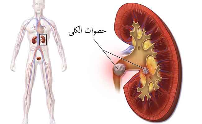 أي أطعمة تساعد على منع تكوّن حصى الكلى؟