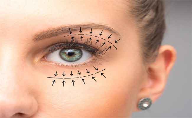 خطوات تسبق جراحة تجميل الجفون...هكذا يتمّ التحضير لها