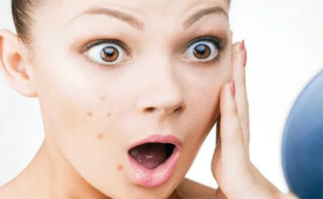 5 خطوات تحمي بشرتك من الحبوب المزعجة!