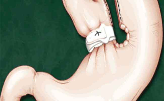 عملية تكميم المعدة...ما هي أضرارها المحتمَلة؟