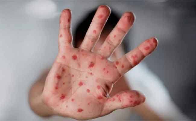 عزل مخالطي المصابين بجدري القردة ضرورة...وهذه هي التدابير المتبعة!