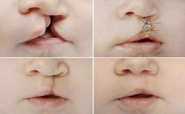 ما هي انواع عمليات التجميل الترميمية؟