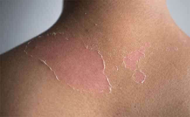 6 نصائح هامة للوقاية من الفطريات الجلدية في الصيف...
