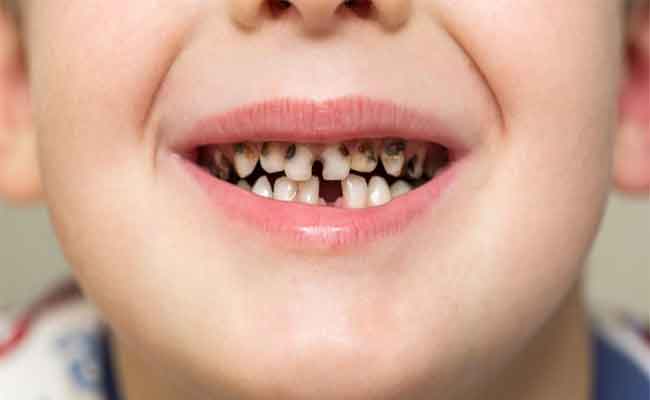 خلع الأسنان اللبنية المتسوسة...متى يكون ضرورياً؟