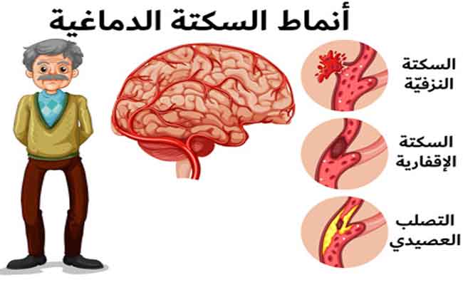 7 أشياء يمكنكم القيام بها للوقاية من السكتة الدماغية...